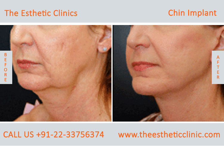 Cheek Augmentation, Cheek Implants surgery before after photos in mumbai india (1)